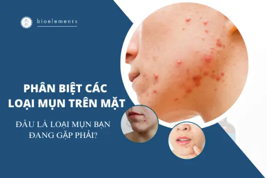 Phân biệt các loại mụn trên mặt: Đâu là loại mụn bạn đang gặp phải?