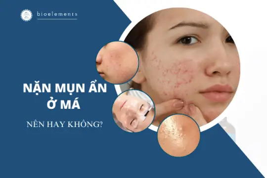 Cách nặn mụn ẩn ở má tại nhà. Nên hay không?