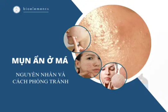 Nguyên nhân, dấu hiệu bị mụn ẩn ở má và cách phòng tránh