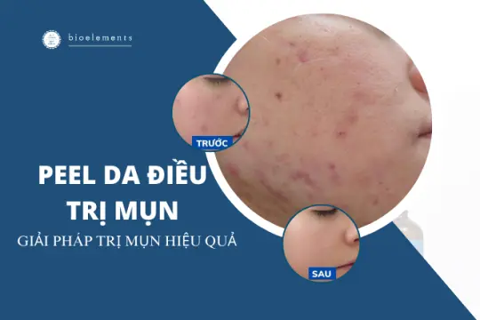 Peel da điều trị mụn: Giải pháp hiệu quả cho vấn đề da mụn.