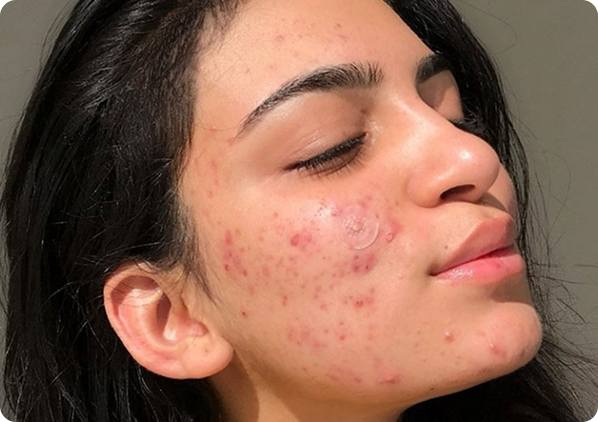 Bạn đang đối mặt với tình trạng mụn trứng cá dai dẳng?