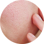 Giảm mụn nhanh chóng
