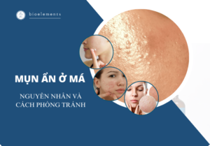 Mụn ẩn ở má. Nguyên nhân và cách phòng tránh