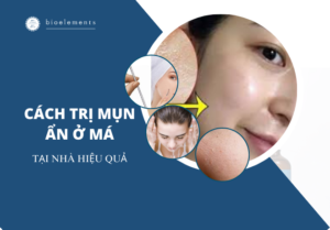 Trị mụn ẩn ở má tại nhà