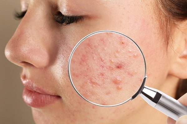 Mụn ẩn ở má là gì