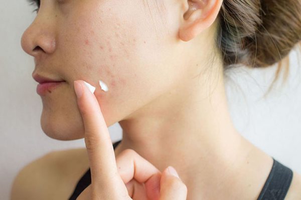 Cách trị mụn ẩn ở má hiệu quả