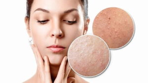 Dấu hiệu mụn ẩn ở má