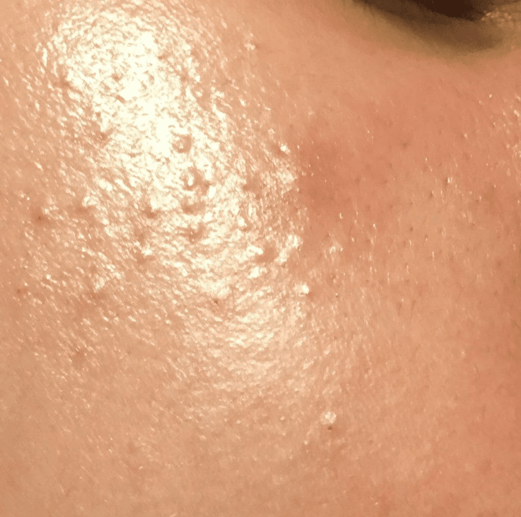 Cách nặn mụn ẩn ở má