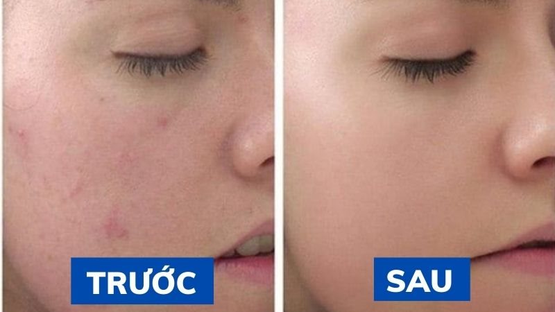 Ưu điểm peel da điều trị mụn