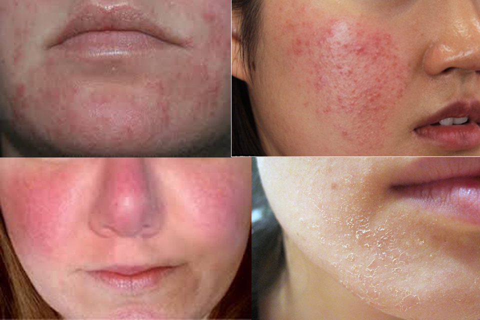 Nhược điểm peel da điều trị mụn