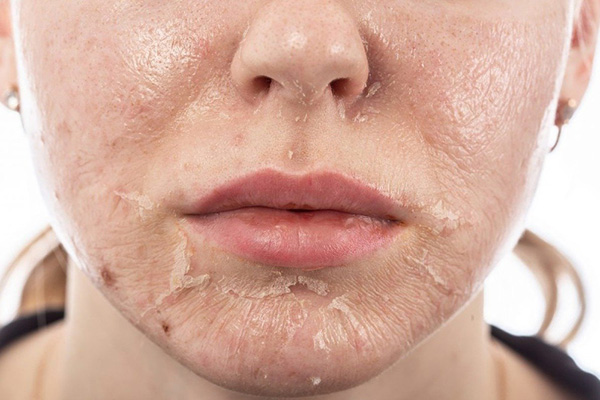 Một số lưu ý chăm da sau peel
