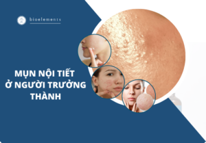 mụn nội tiết ở người trưởng thành