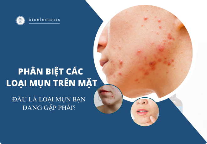 Phân biệt các loại mụn